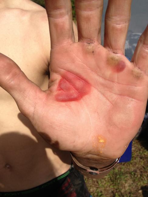 Landon Wolfe's hands after Round 1 