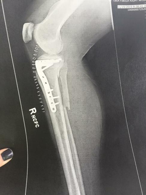The X-ray of Melonie's leg.Photo: Courtesy of Scott McManus
